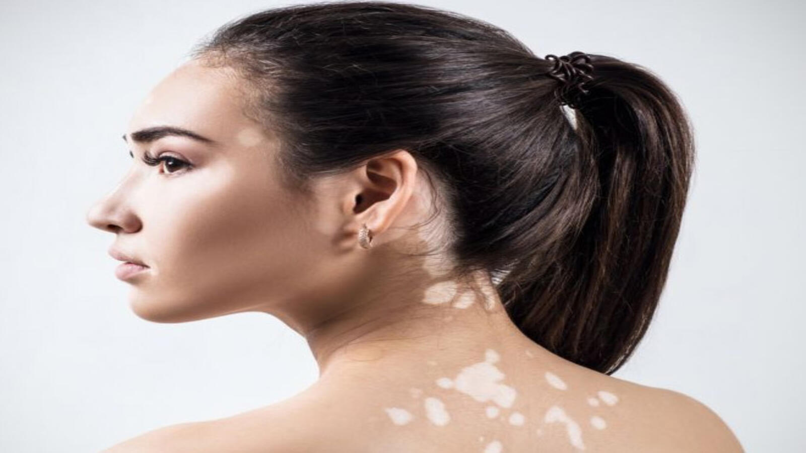 White spot on face : क्या छूने से फैलता है सफेद दाग नाम का त्वचा रोग ?