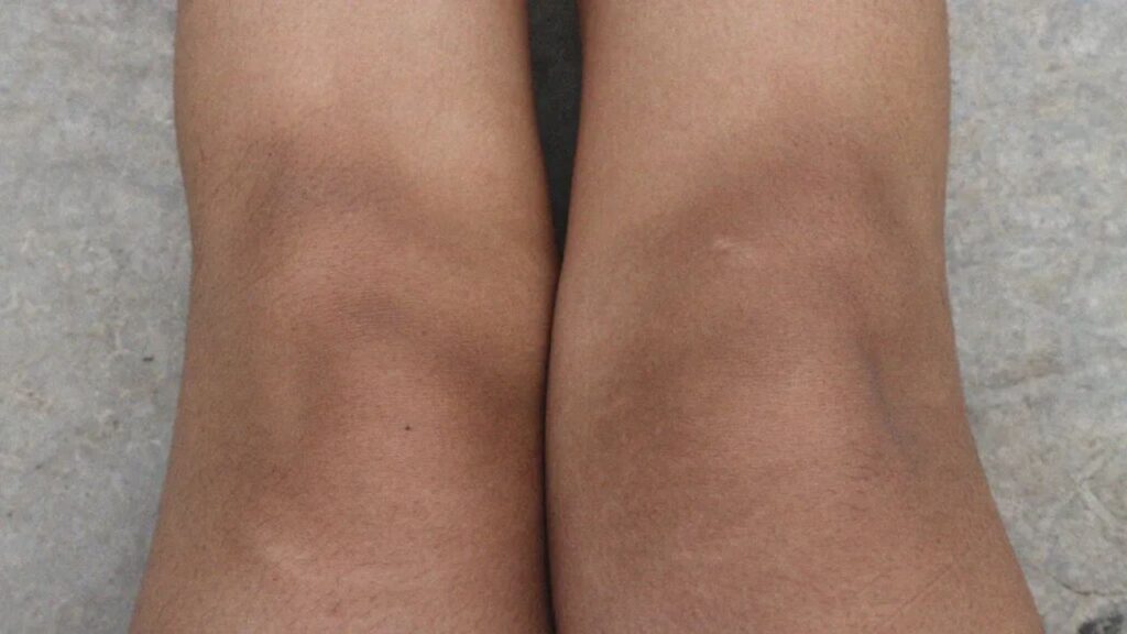 Home Remedies for Dark Knees