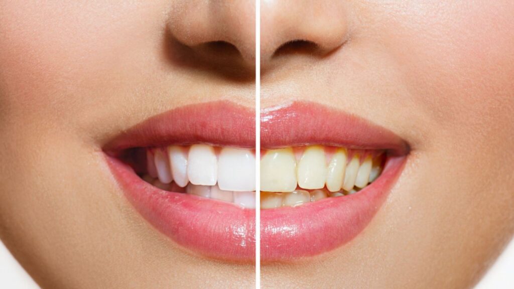 Teeth Plaque Removal at Home