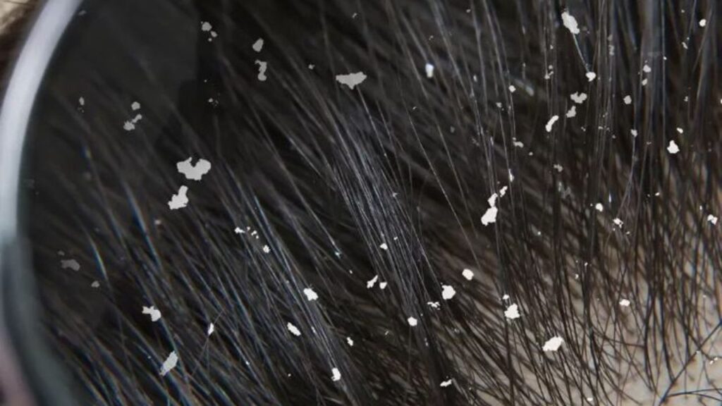 dandruff treatment at home