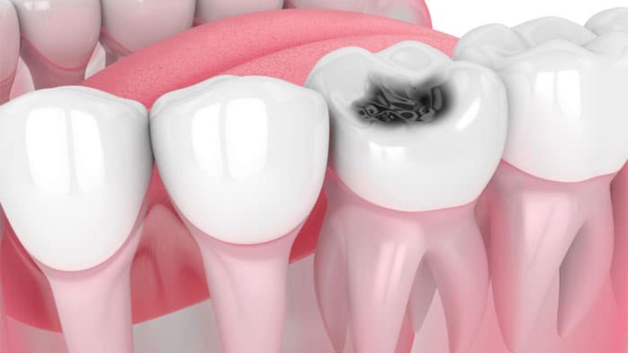 Dental Cavity Home Remedy