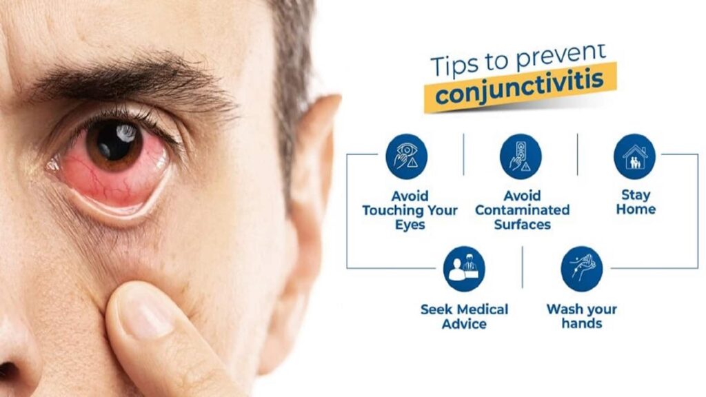 Conjunctivitis In Hindi