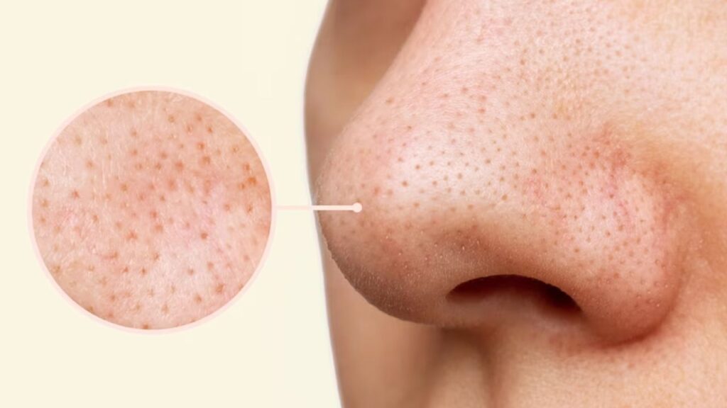 Blackhead Removal Home Remedy