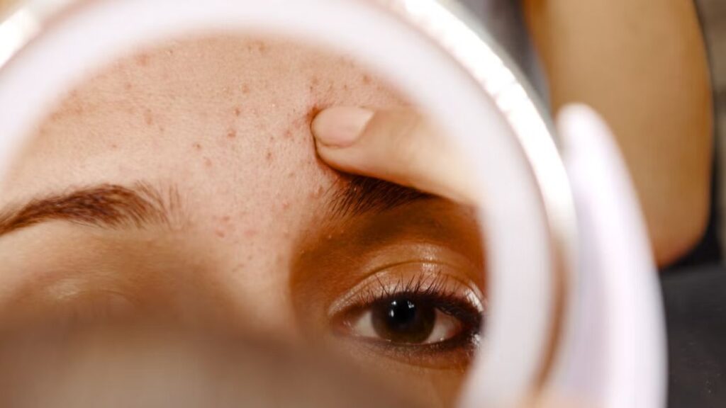 Blackhead Removal Home Remedy