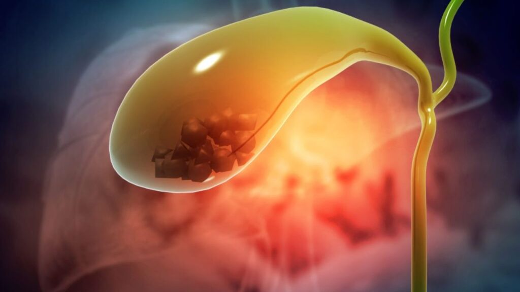 Gallbladder Stone Home Remedy