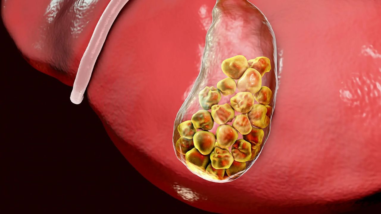 Gallbladder Stone Home Remedy: पित्ताशय की पथरी के खतरे से हो जाएं सावधान, करें यह घरेलू उपाय