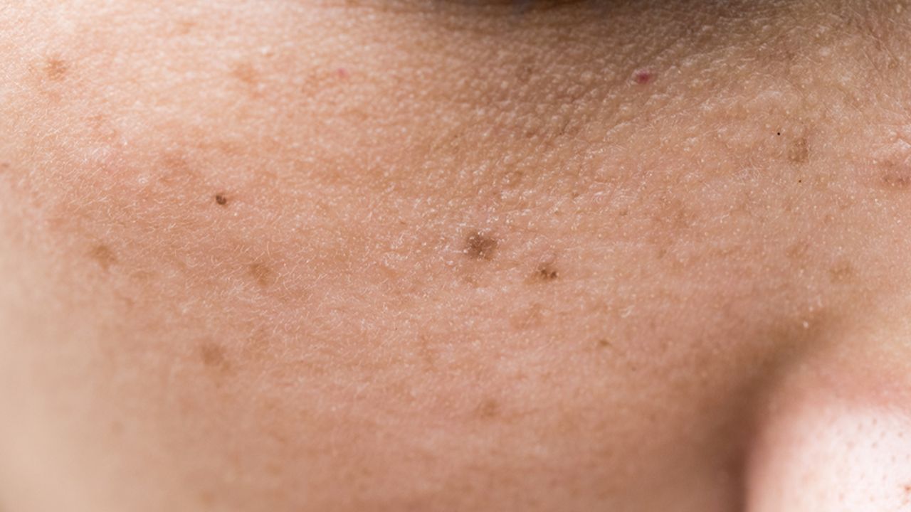 Home Remedy For Pigmentation