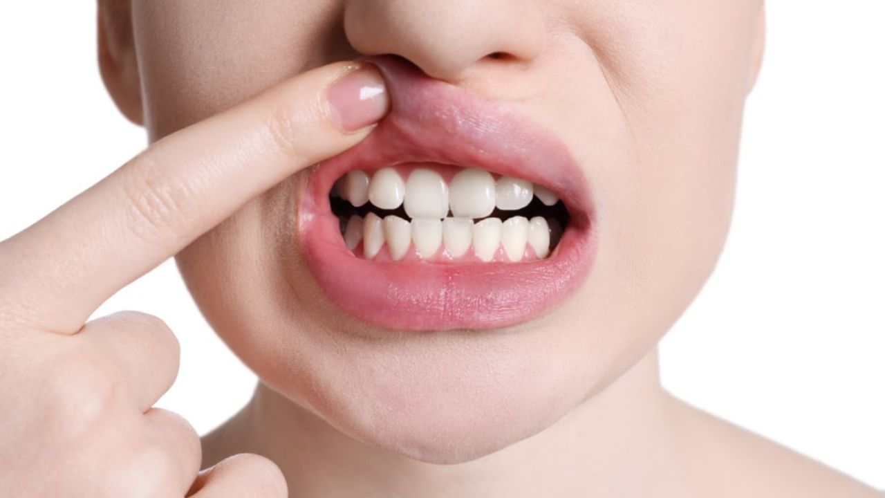 Mouth Ulcers Home Remedy: बार-बार हो जाते हैं मुंह के अल्सर से परेशान तो जाए यानी इसका आयुर्वेदिक समाधान