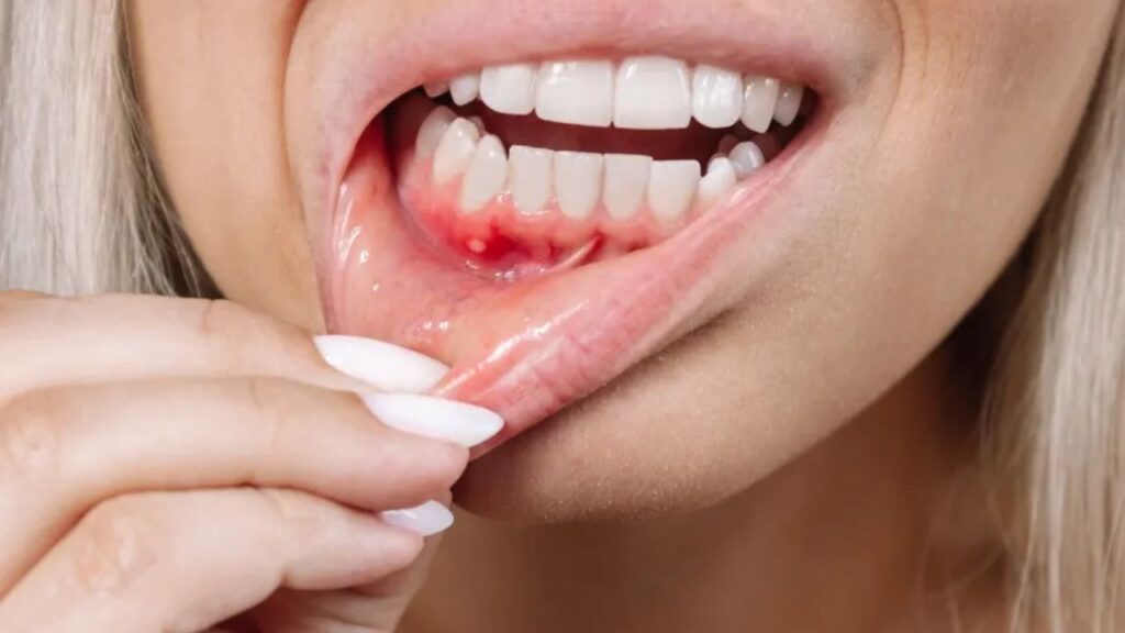 Mouth Ulcers Home Remedy