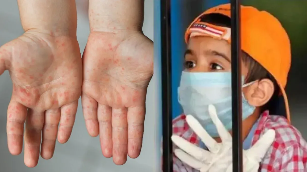 दिल्ली में बढ़ रहे हैं हैंड, फुट एंड माउथ डिजीज के मामले (HFMD Outbreak), जानें कारण, लक्षण और इलाज