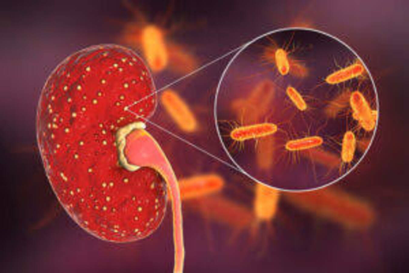 Kidney Infection Symptoms