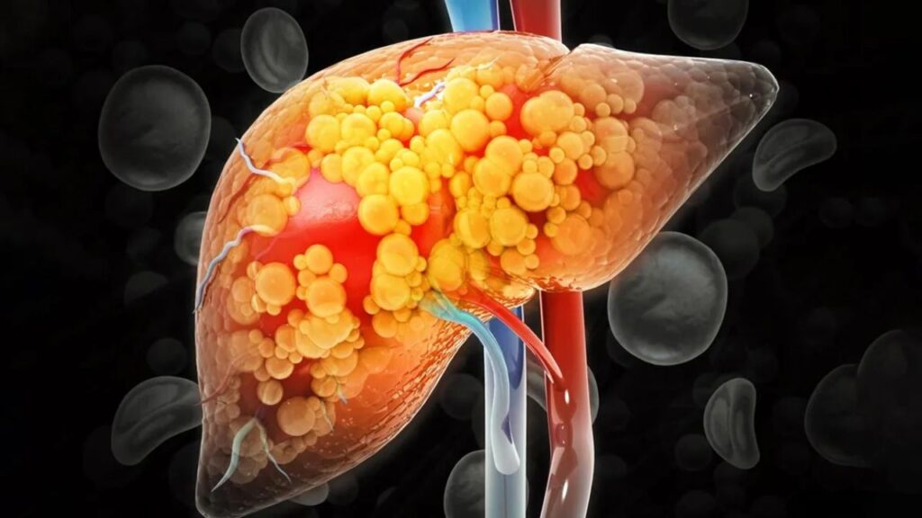 Grade 1 Fatty Liver Symptoms and Remedy