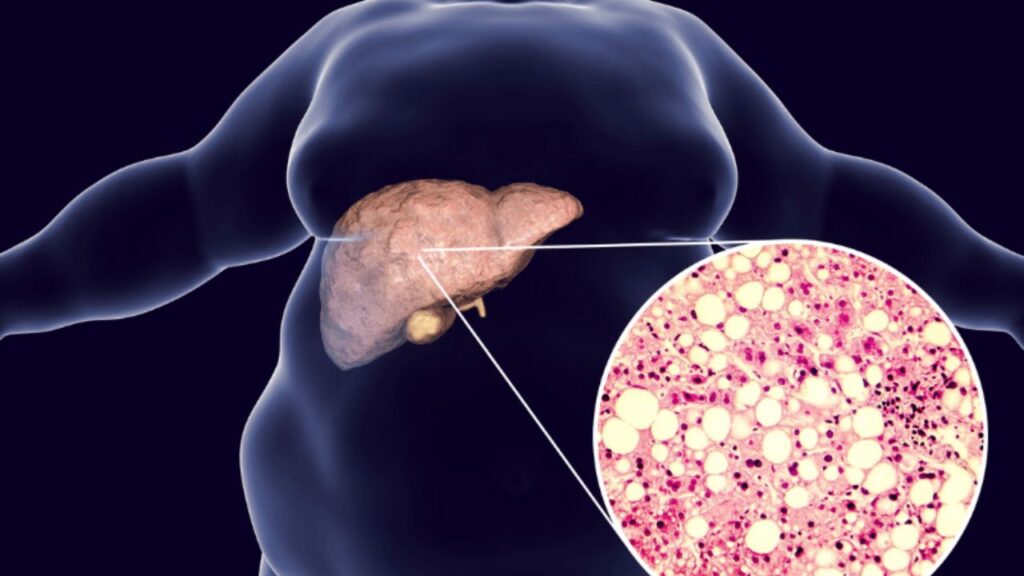 Grade 1 Fatty Liver Symptoms and Remedy