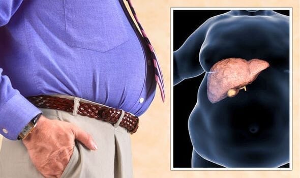 Liver Fatty Symptoms : फैटी लिवर में दिखते हैं ये पांच लक्षण, ऐसे करें पहचान 