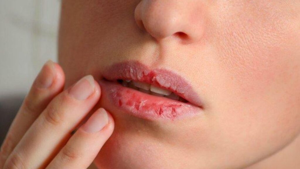 Remedy for Cracked Chapped Lips