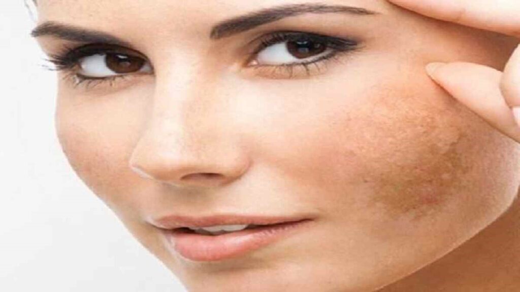Winter Skin Care Tips for Removing Pigmentation