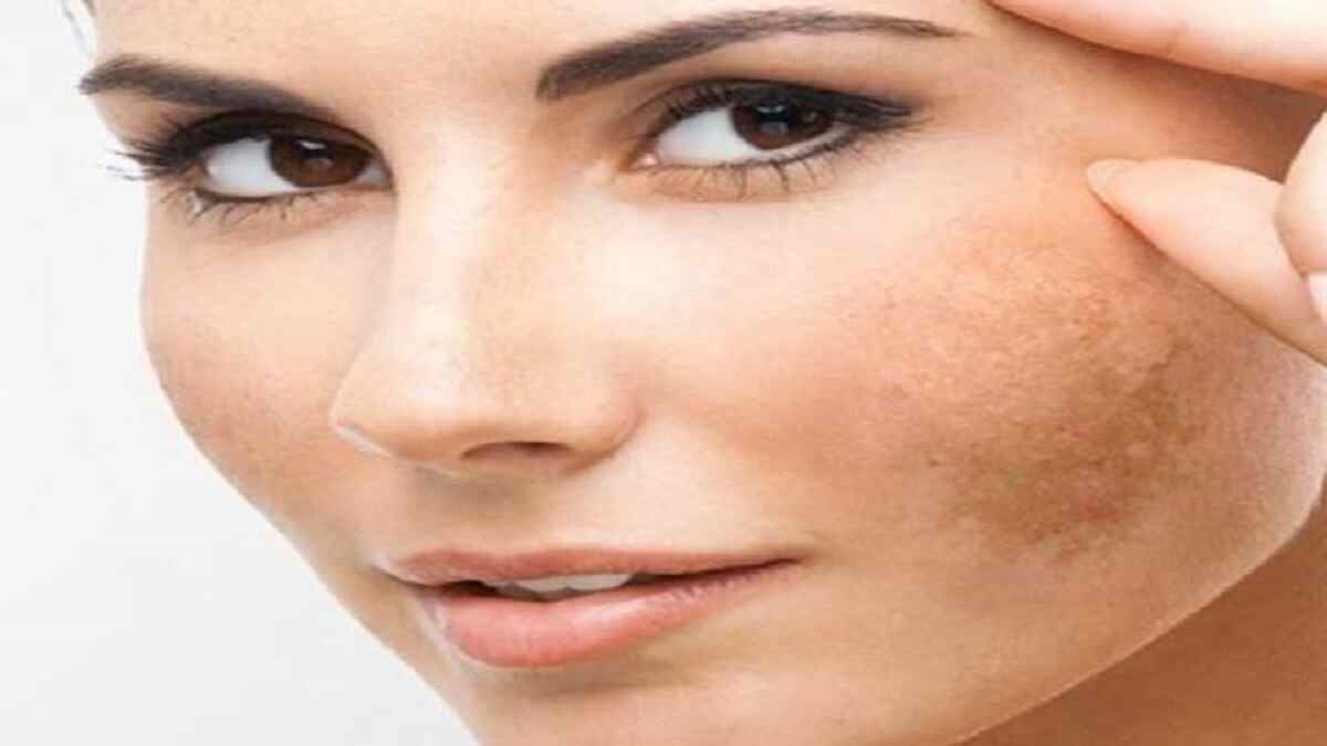 Winter Skin Care Tips for Removing Pigmentation