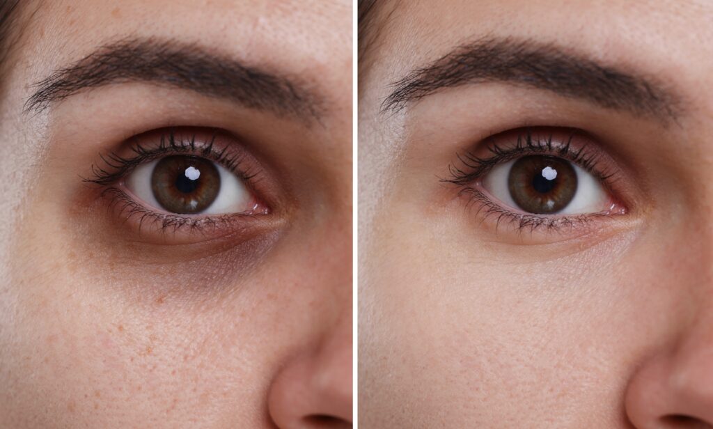 Remedy For Dark Circle Eye