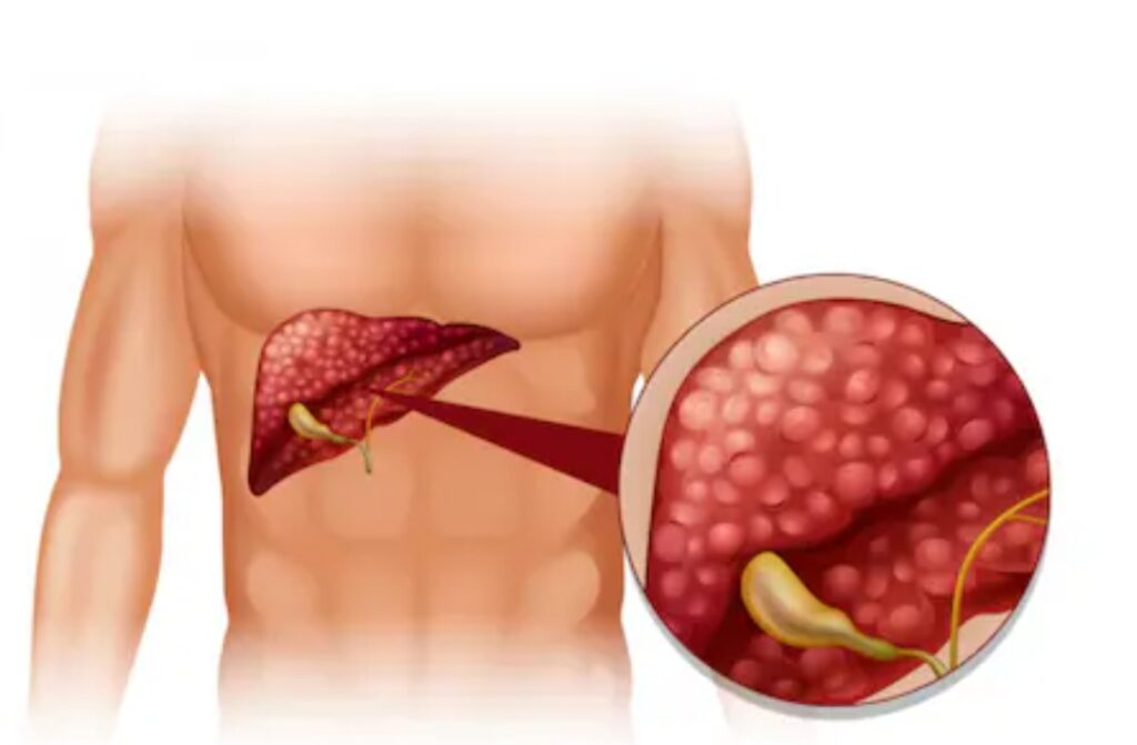 These 3 easy lifestyle changes can reverse fatty liver, doctor's advice