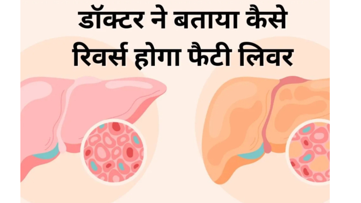 These 3 easy lifestyle changes can reverse fatty liver, doctor's advice