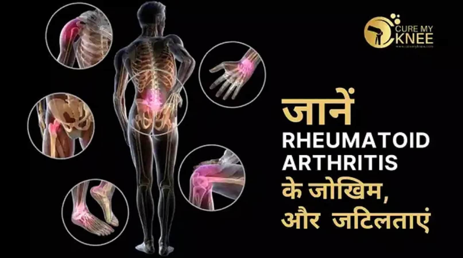 Learn About RA Factor -कुछ रोगी RF