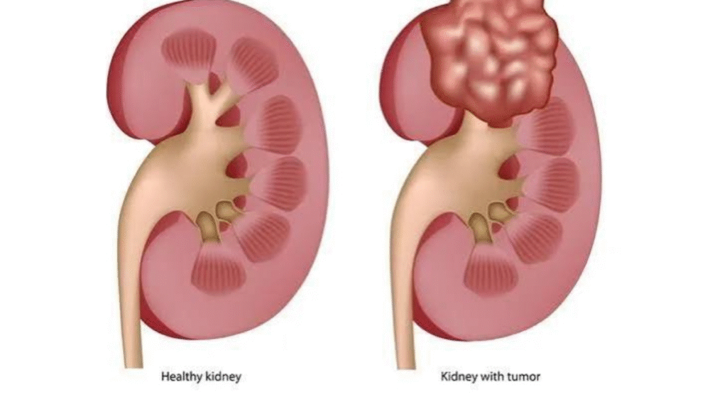 Kidney Stone vs. Cancer: Do not ignore pain near the kidney; find out when it could be a sign of cancer.