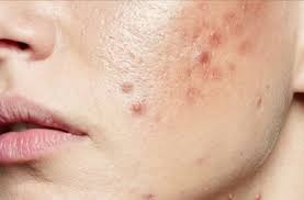 Unhealthy Stomach Affects Skin Health