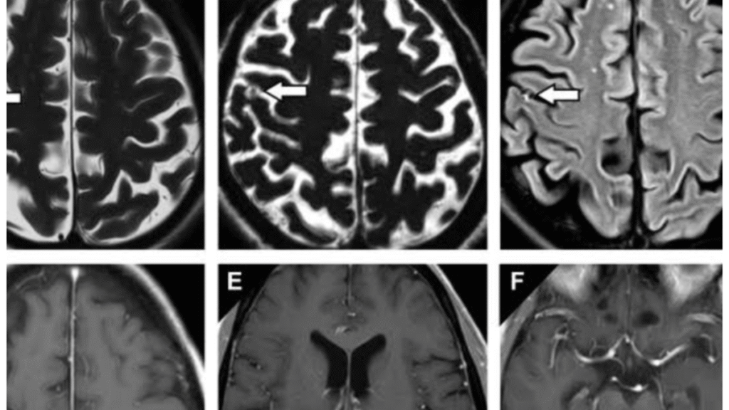 38 parasites found in the brain of a UK woman; learn what neurocysticercosis is and how to prevent it.
