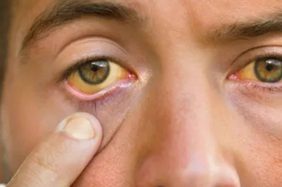 Yellowing of the eyes could be a sign of a liver disorder; doctor lists 5 early symptoms.