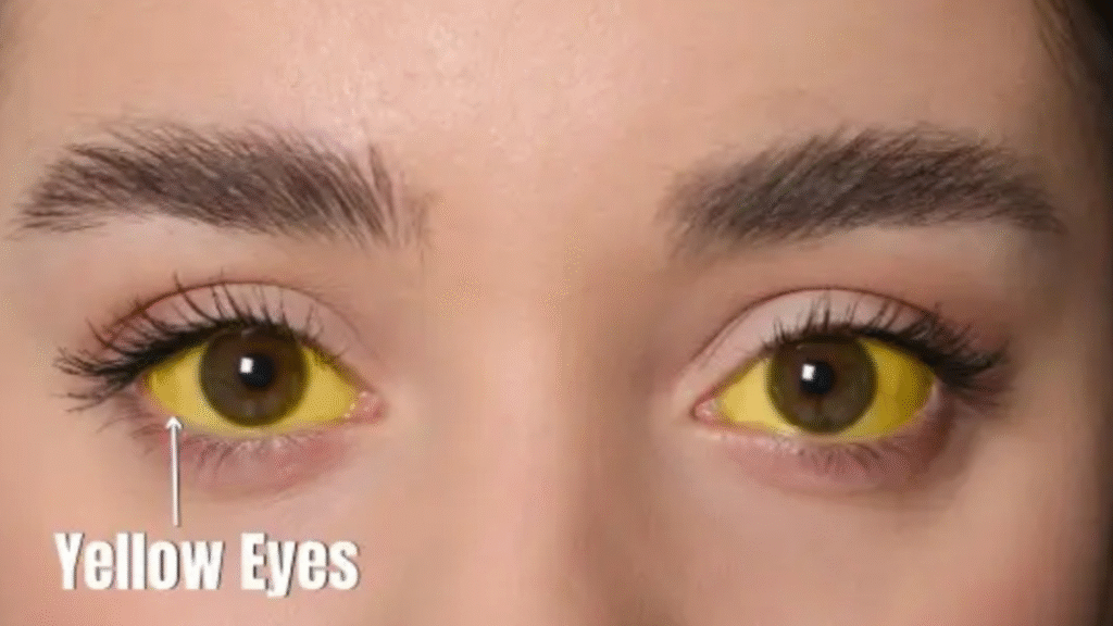 Yellowing of the eyes could be a sign of a liver disorder; doctor lists 5 early symptoms.