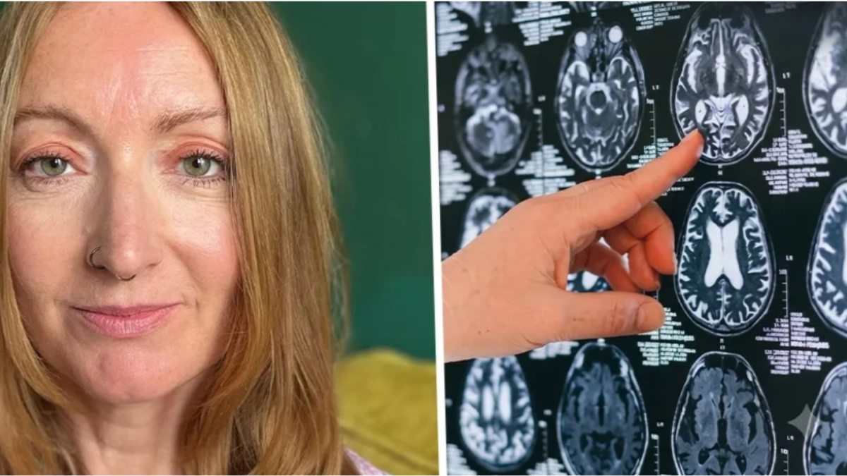 38 parasites found in the brain of a UK woman; learn what neurocysticercosis is and how to prevent it.