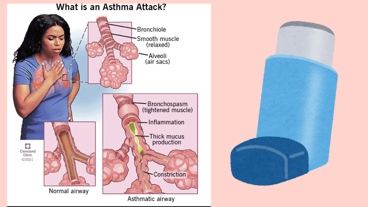 Why does asthma become more severe in women? Learn about the causes and the challenges of treatment.