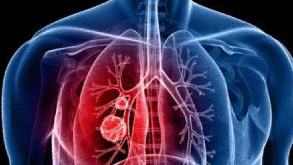 When can a persistent cough, chest pain, and shortness of breath be signs of lung cancer?