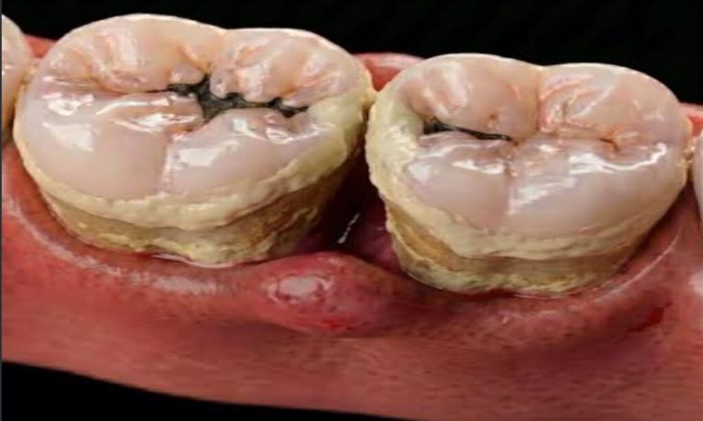 Food Stuck Teeth Remedy