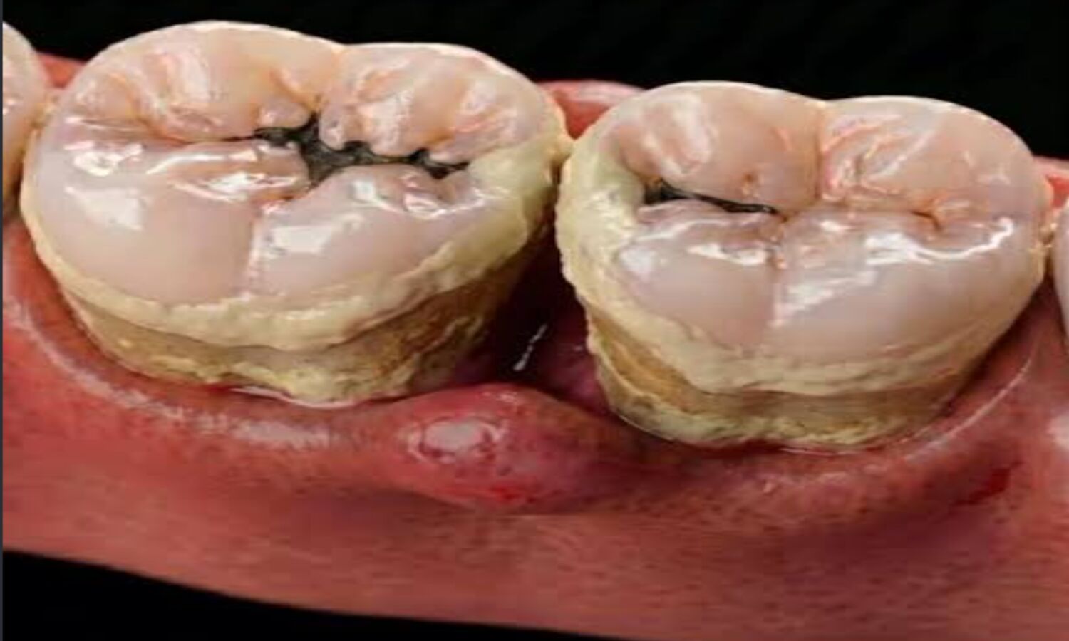 Food Stuck Teeth Remedy
