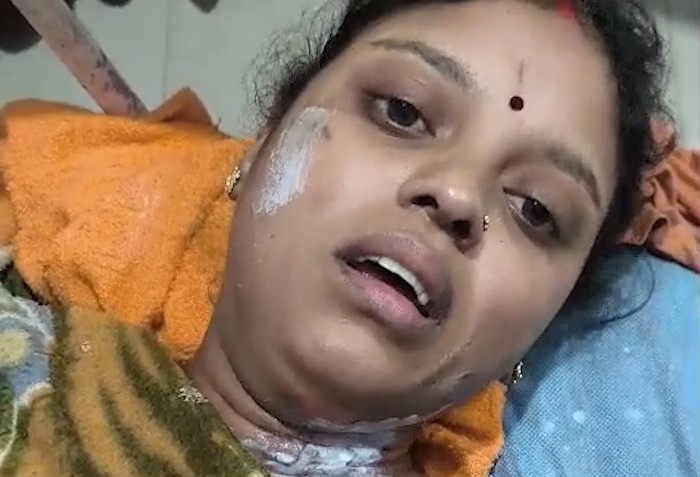 Woman set on fire after being doused with petrol in Sidhi dies at SGMH Rewa